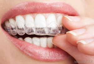 Teeth Whitening 20